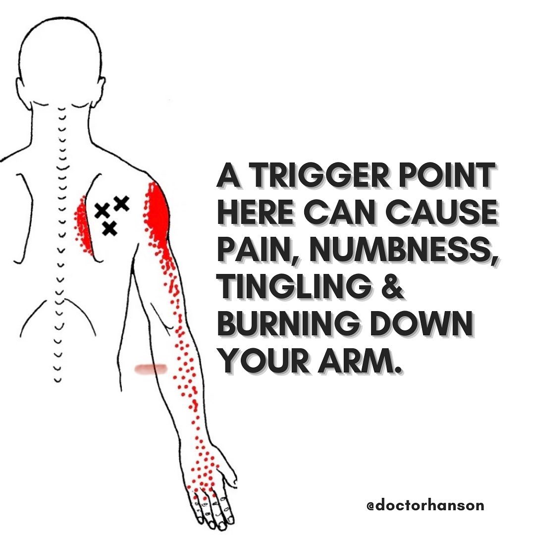 Trigger Points In The Shoulder Can Cause Numbness In The Hand 