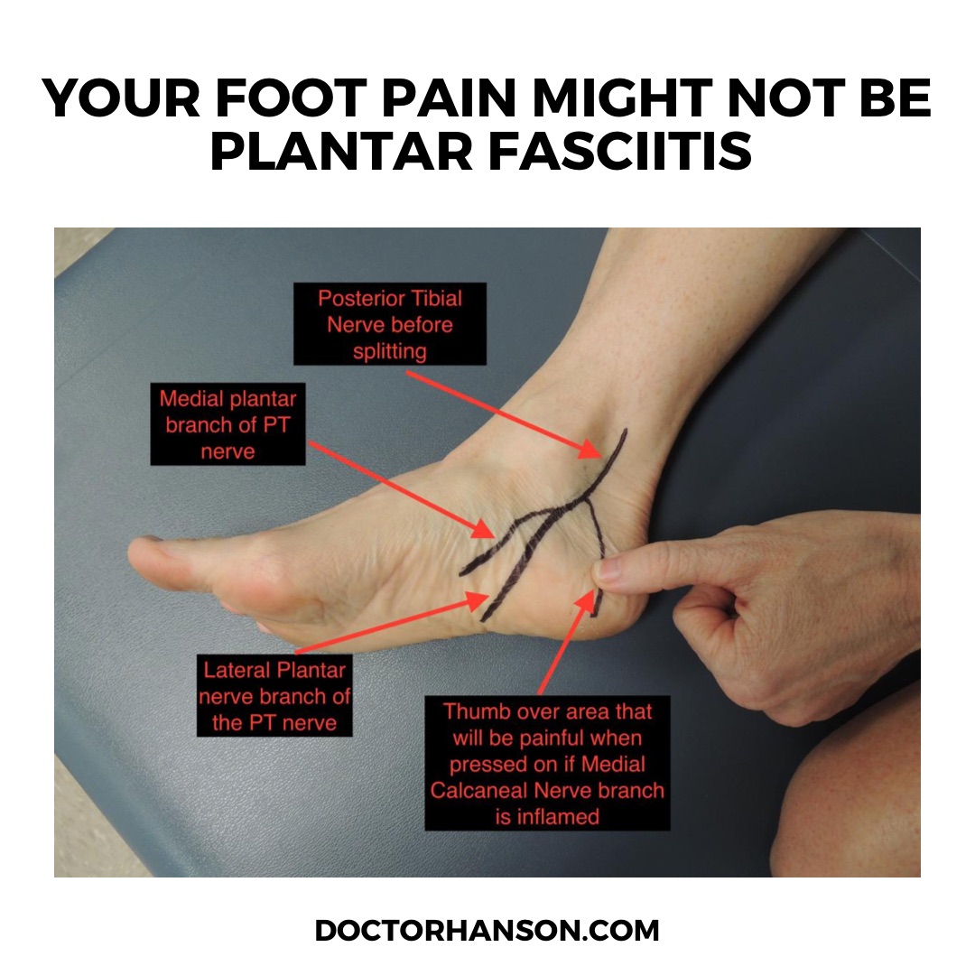 Is your foot pain really plantar fasciitis? Acupuncture , Dry