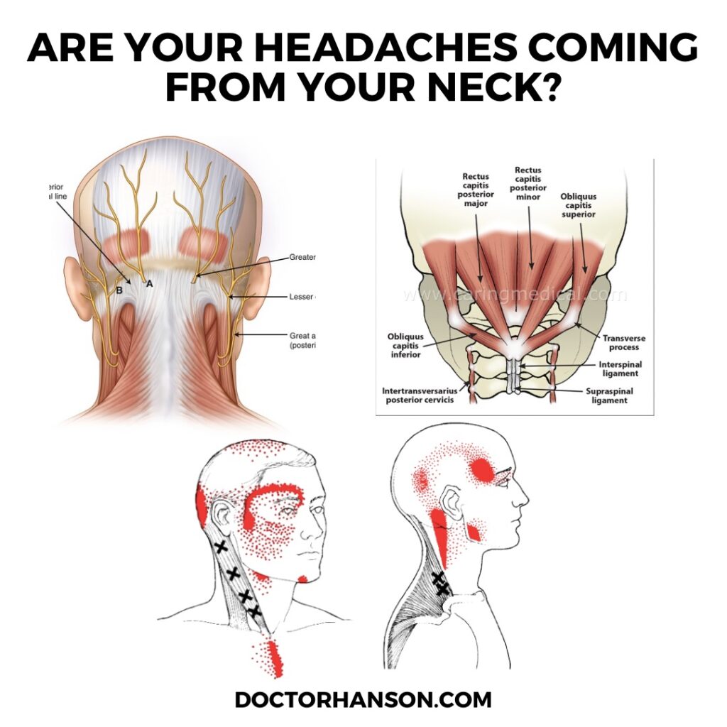 Are your headaches coming from your neck? Acupuncture , Dry Needling