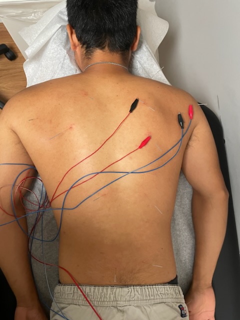 What Is Neurofunctional Acupuncture Acupuncture Dry Needling Prolotherapy In Tampa Fl